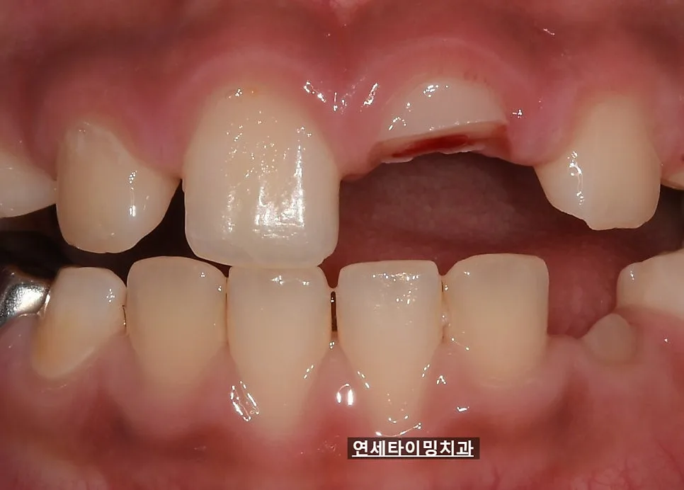 강동구 소아 앞니 파절, MTA 신경 보호와 당일 레진 수복 관련 사진 3