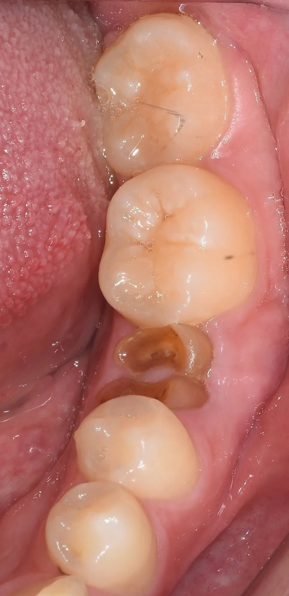 길동역 발치 즉시 임플란트, 뿌리만 남은 치아를 정리하는 순서 관련 사진 2