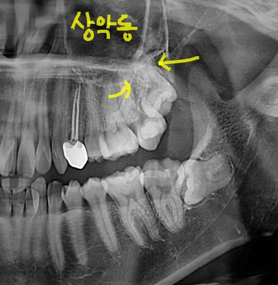 위쪽 매복 사랑니 발치와 상악동, 코로 물이 넘어가는 증상 관련 사진 2
