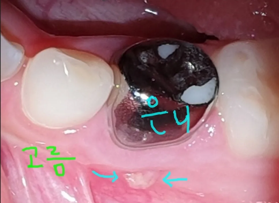 어린이 은니가 흔들릴 때, 발치 후 공간유지장치가 필요한 이유 관련 사진 4