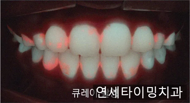 치아에 금이 갔을 때, 큐레이 진단과 치료 방향 정하기 관련 사진 4