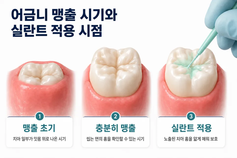 길동역 실란트, 어금니 적용 시기와 유지 관리 기준 관련 사진 3