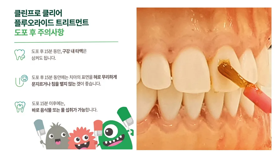 프리미엄 불소도포 후 주의사항과 도포 장면