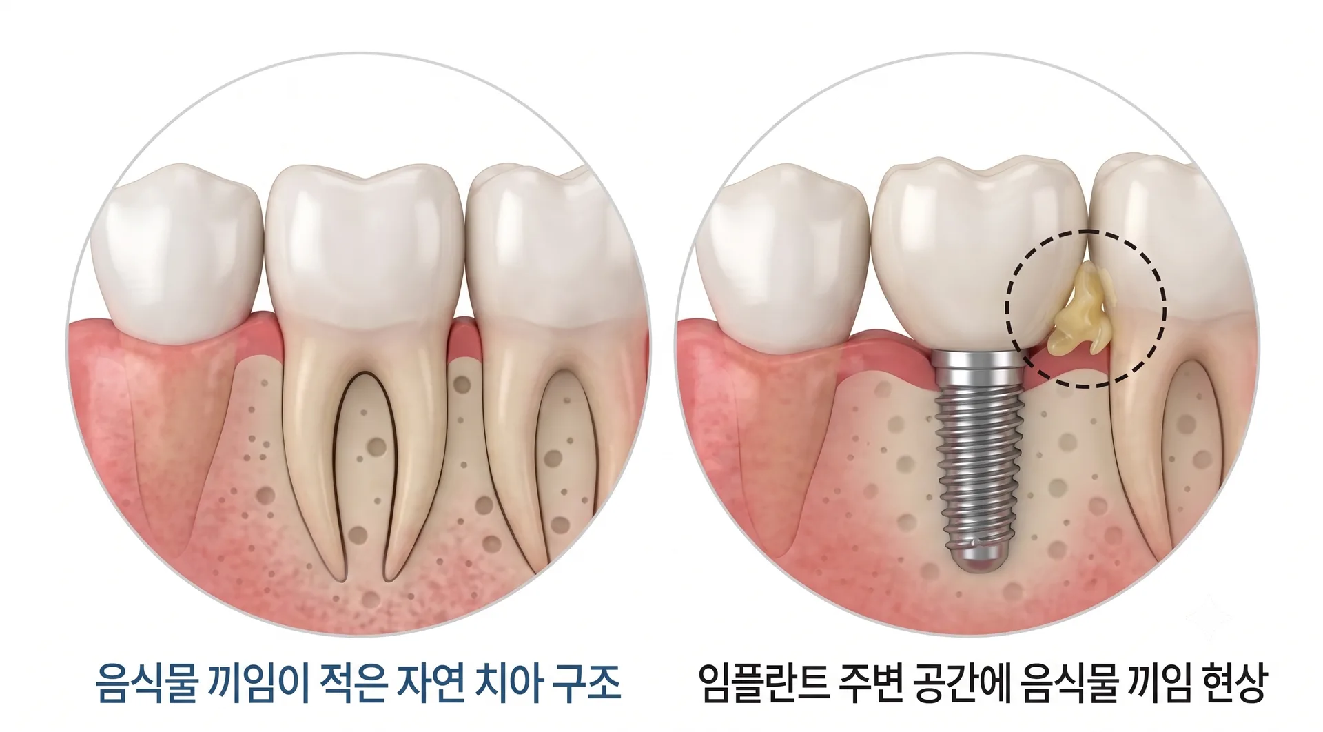 자연치아와 임플란트 주변의 음식물 끼임 차이 안내