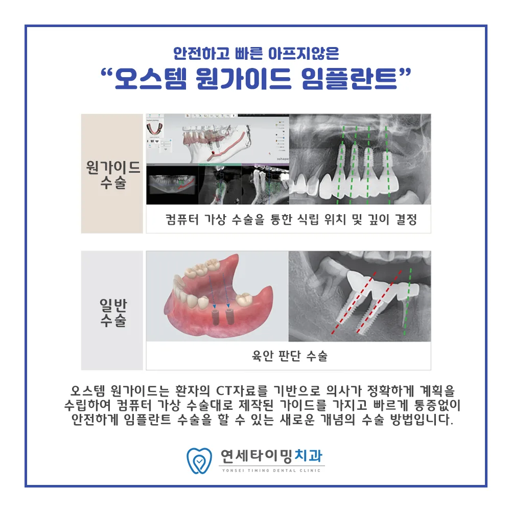임플란트