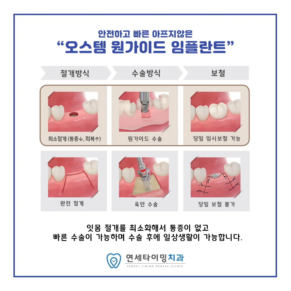 원가이드 임플란트 진행 단계 안내